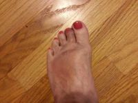 My broken toe!