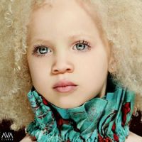 Albino Beauty