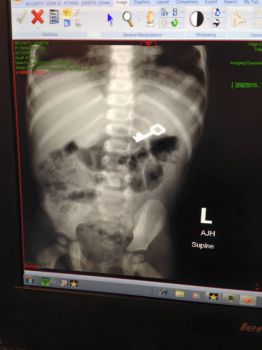 x-ray of swallowed key