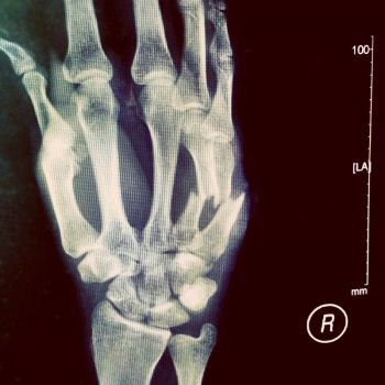 Ben's broken hand 2013, January
