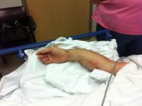 Brad'sBrokeArm
